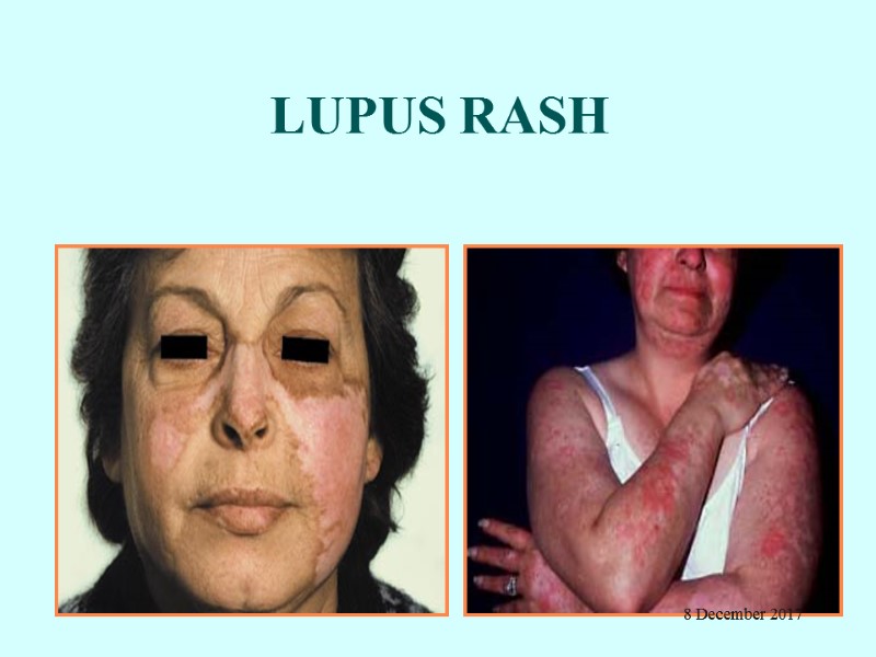 LUPUS RASH 8 December 2017